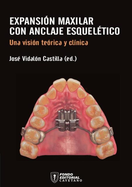 Expansión maxilar con anclaje esquelético:Una visión teórica y clínica