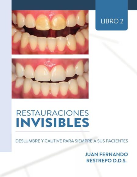 Restauraciones Invisibles: Deslumbre Y Cautive Para Siempre A Sus Pacientes