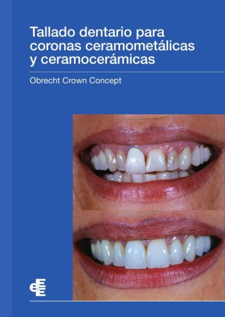 Tallado dentario para coronas ceramometálicas y ceramocerámicas:Obrecht Crown Concept