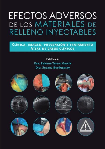 Efectos adversos de los materiales de relleno inyectables